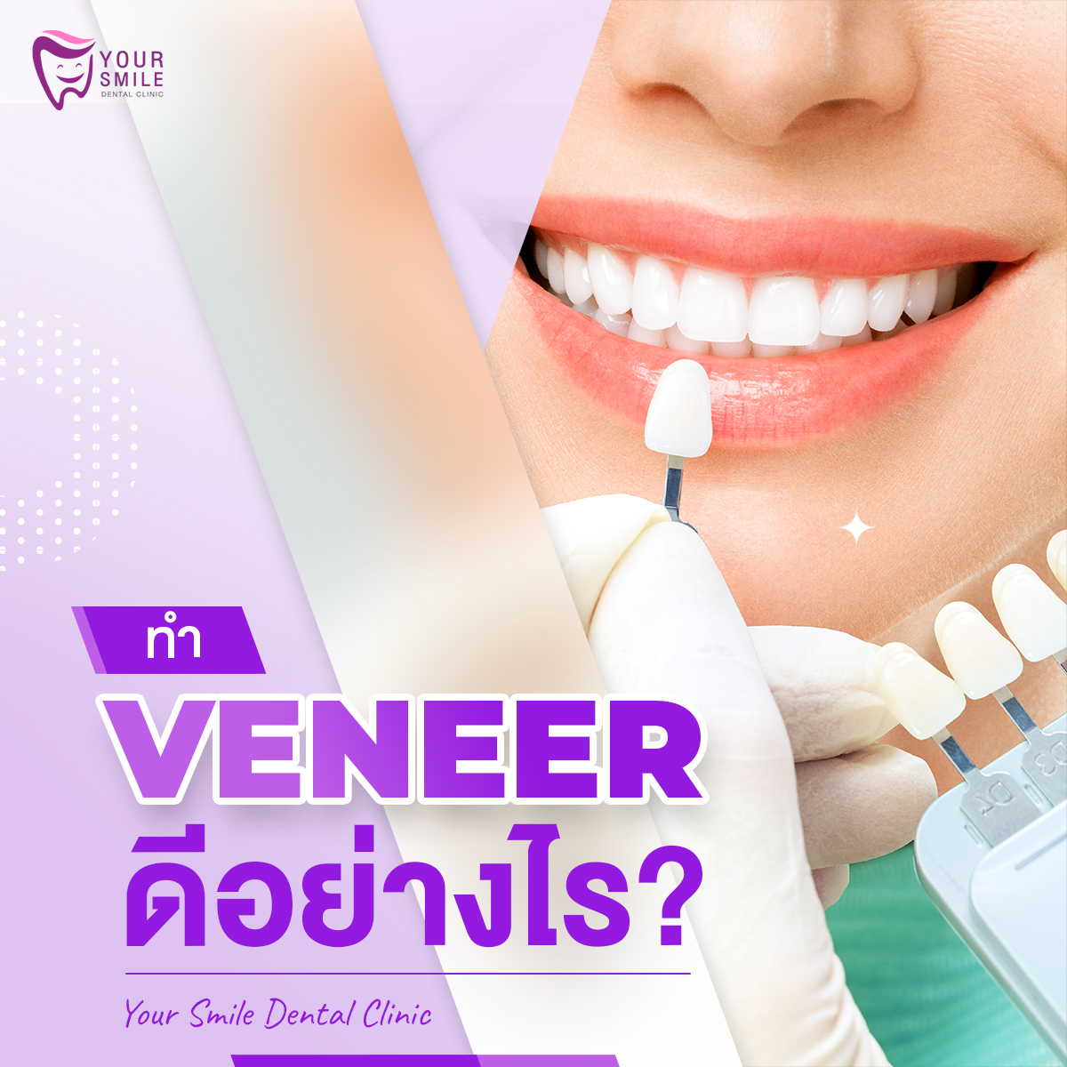 Veneer ดีอย่างไร