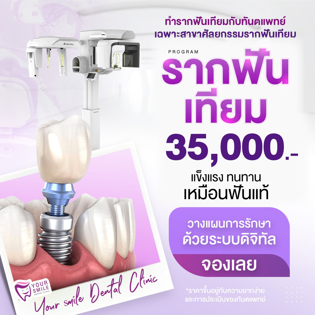 โปรโมชัน รากฟันเทียม