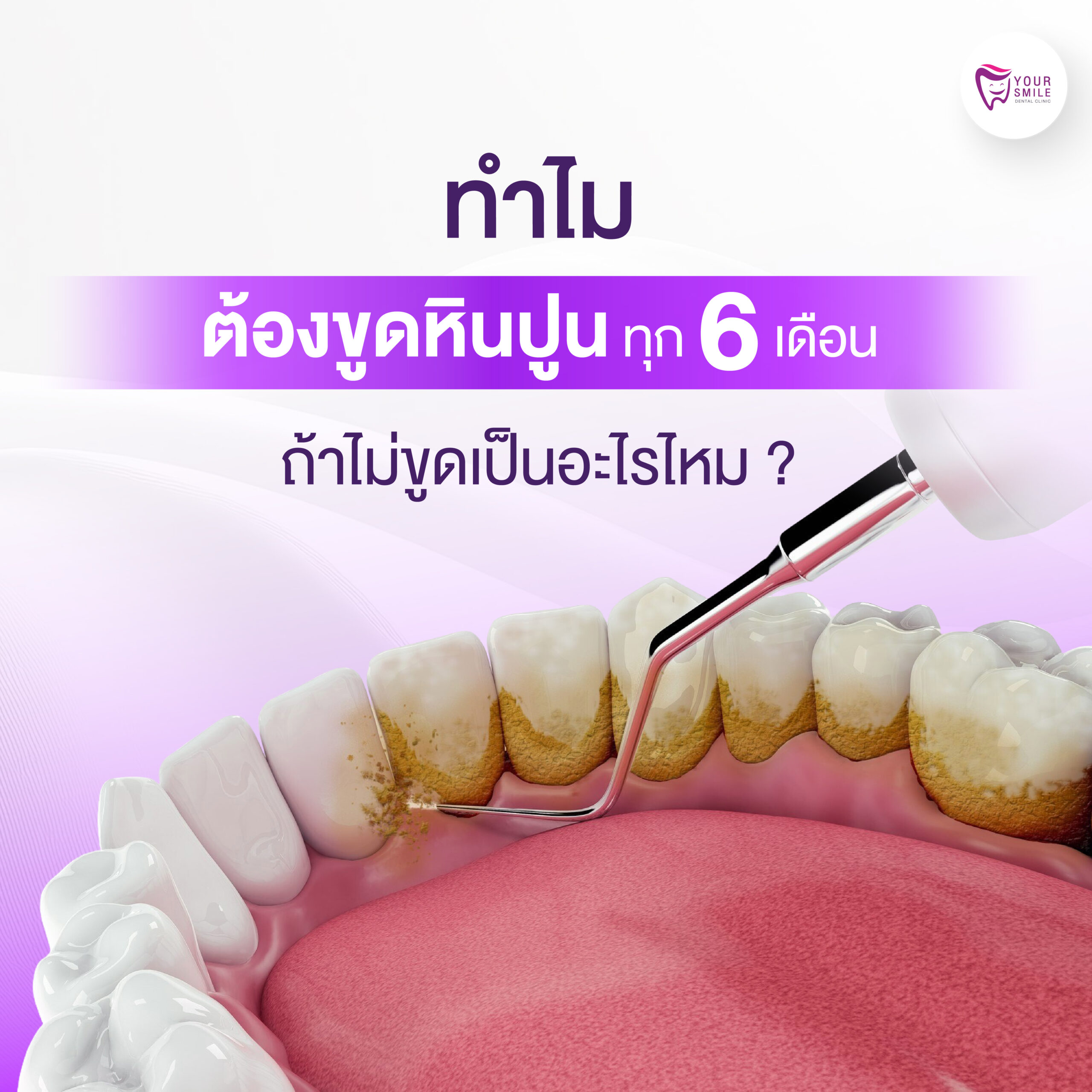ทำไมต้องขูดหินปูน