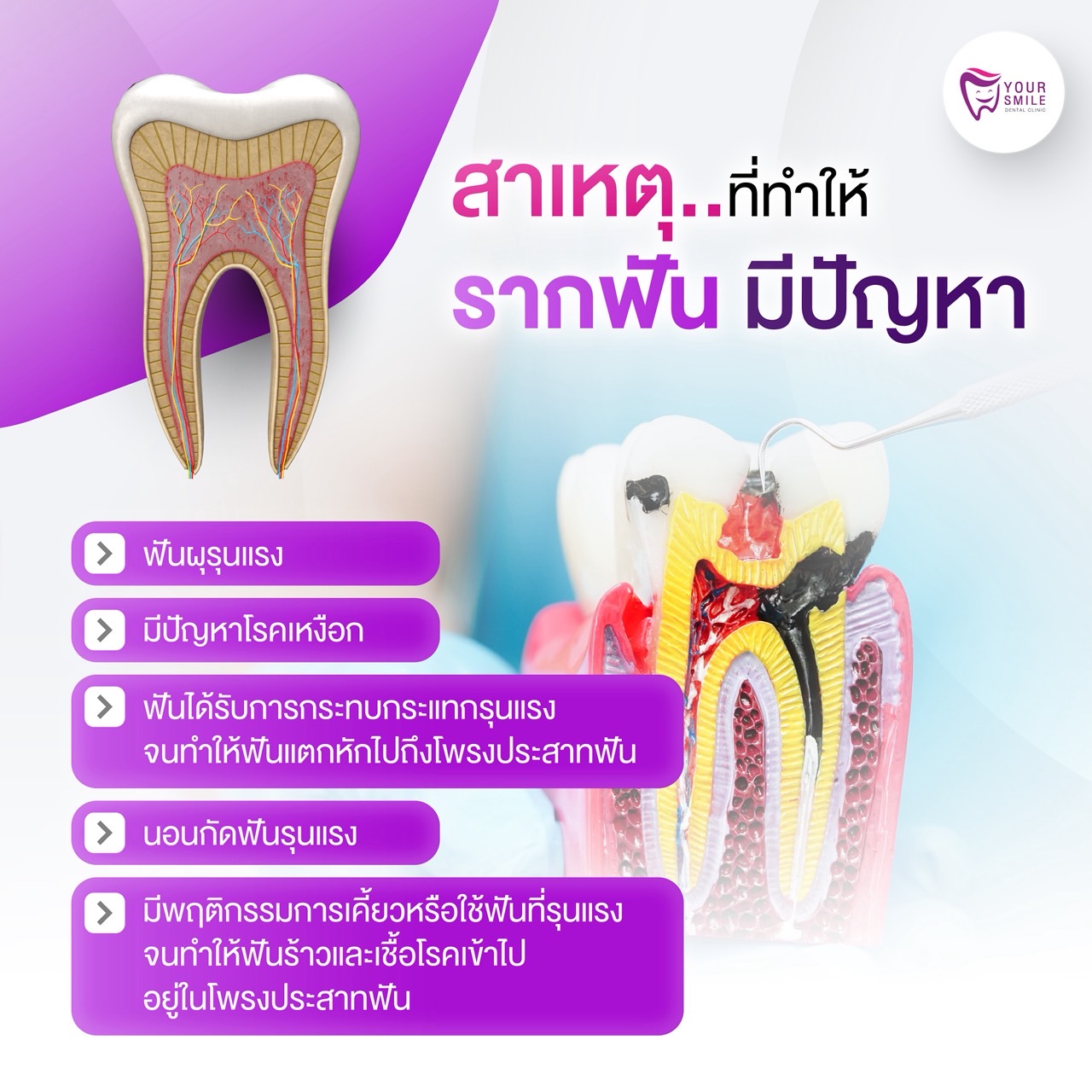 สาเหตุ ที่ทำให้รากฟันมีปัญหา