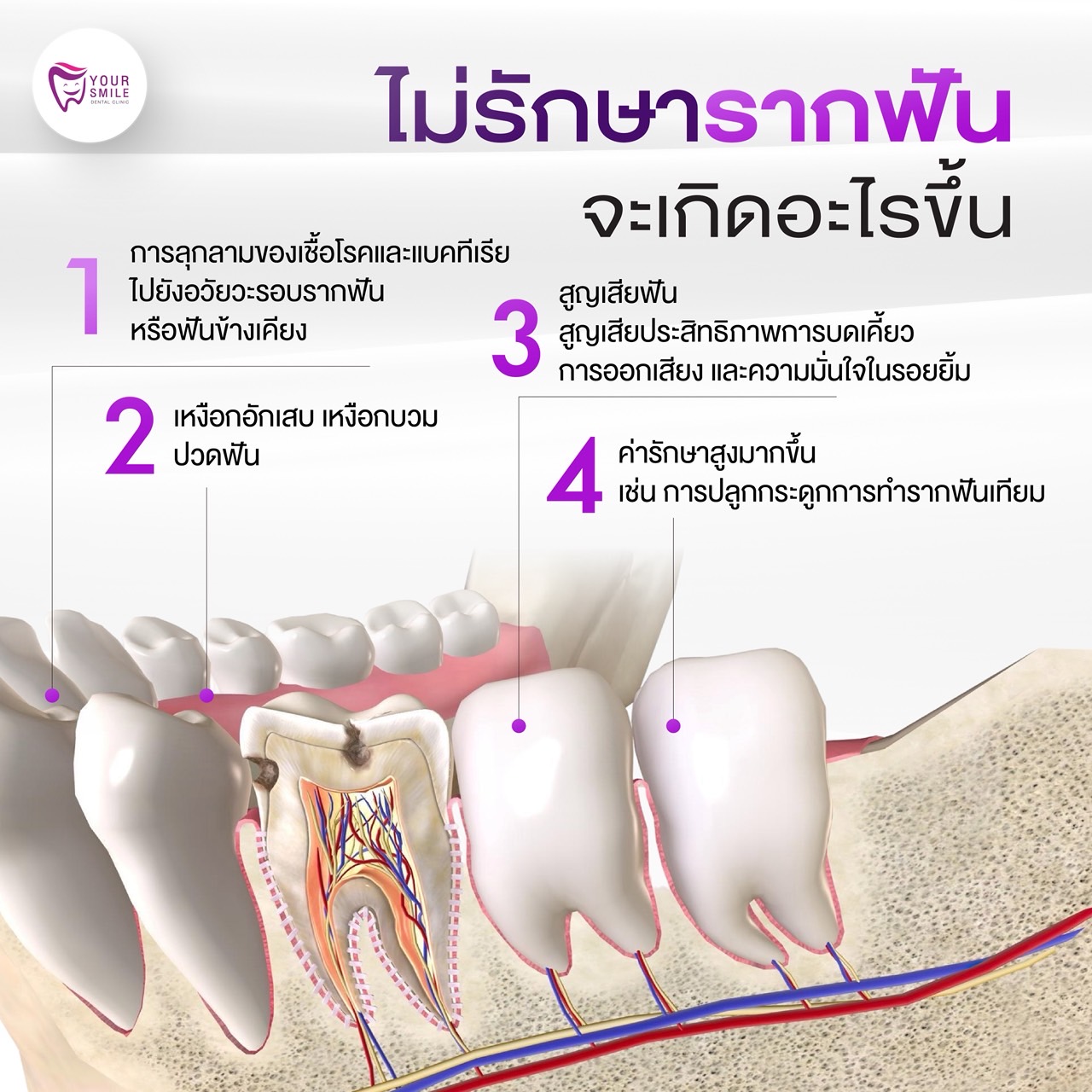 ไม่รักษารากฟัน จะเกิดอะไรขึ้น