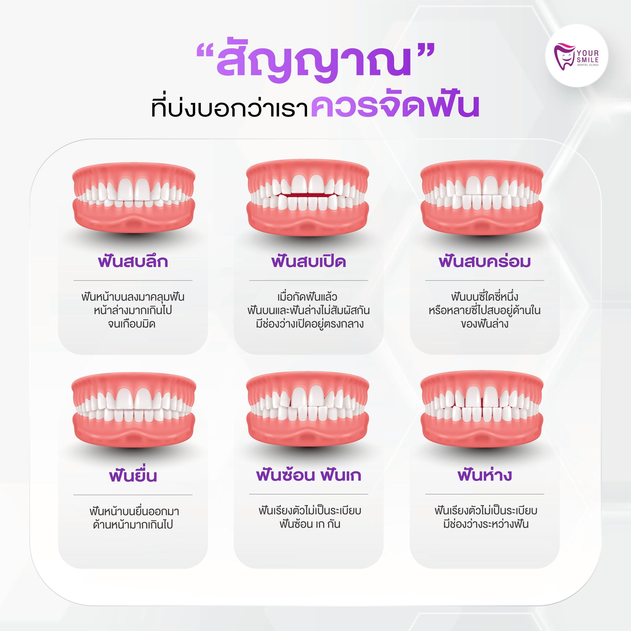 สัญญาณที่บอกว่าควรจัดฟัน